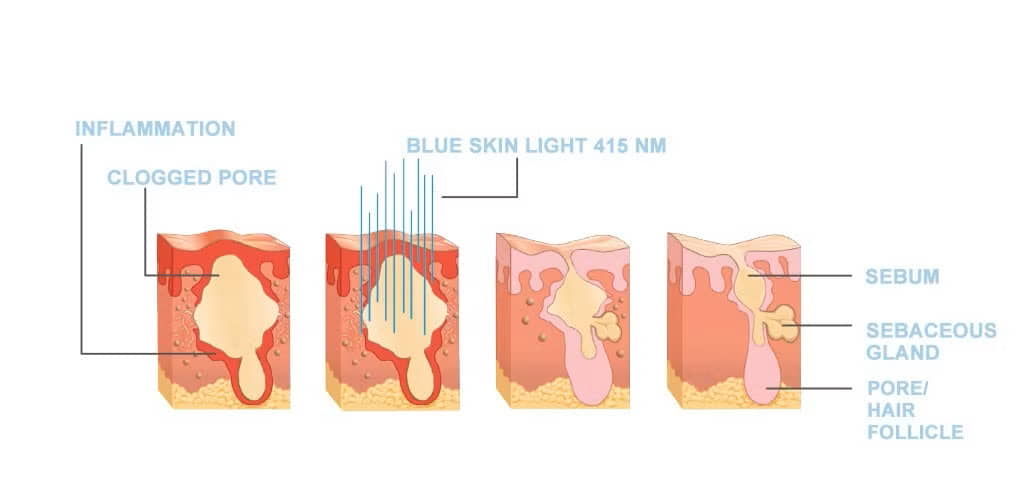 Blått ljus verkning